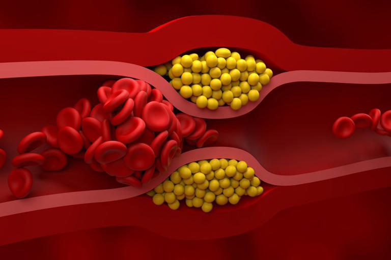 Illustration showing the interior of an artery blocked by atherosclerosis